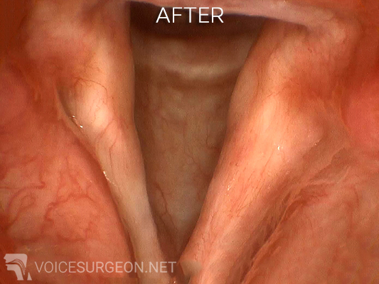 Vocal cord dysplasia: after surgery