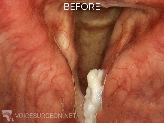 Vocal cord dysplasia: before surgery