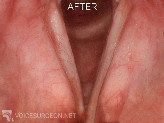 Vocal cord dysplasia: after surgery