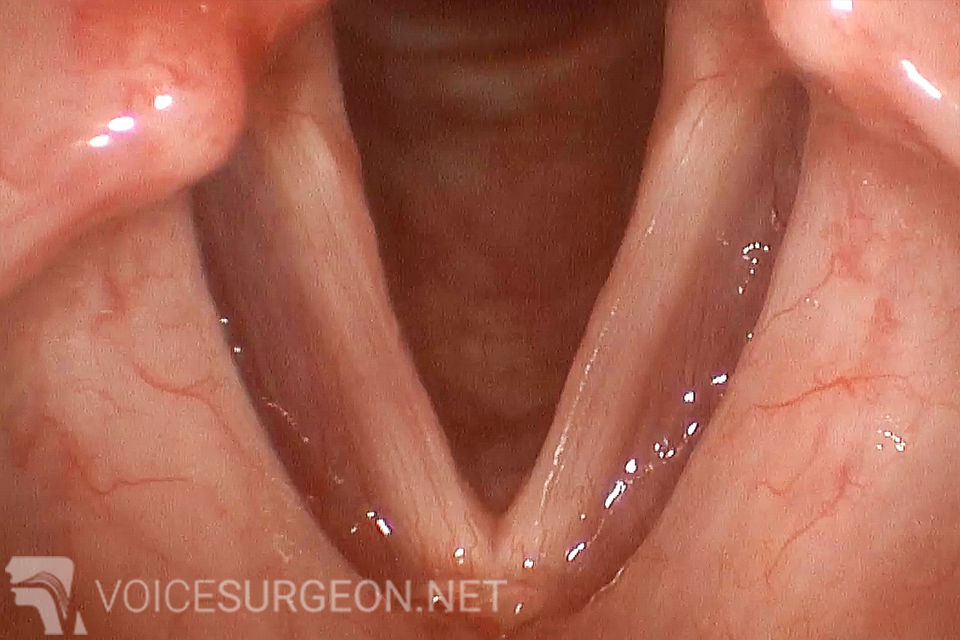 After Vocal Cord Nodules Cancer Surgery