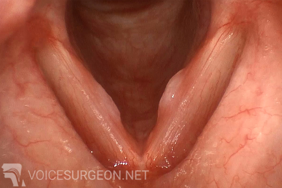 Before Vocal Cord Nodules Cancer Surgery