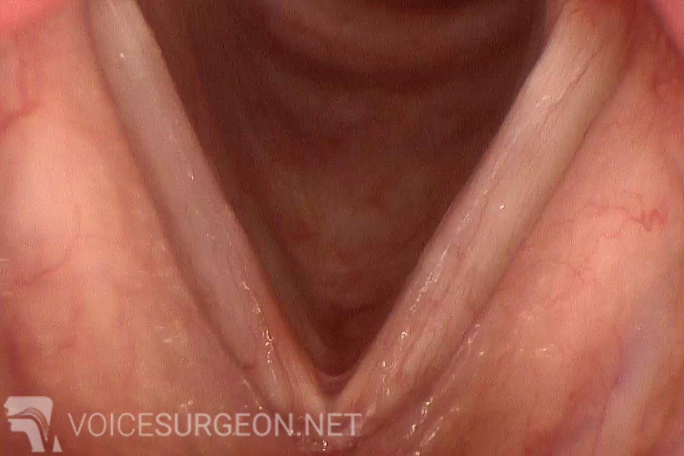 After Vocal Cord Nodules Cancer Surgery