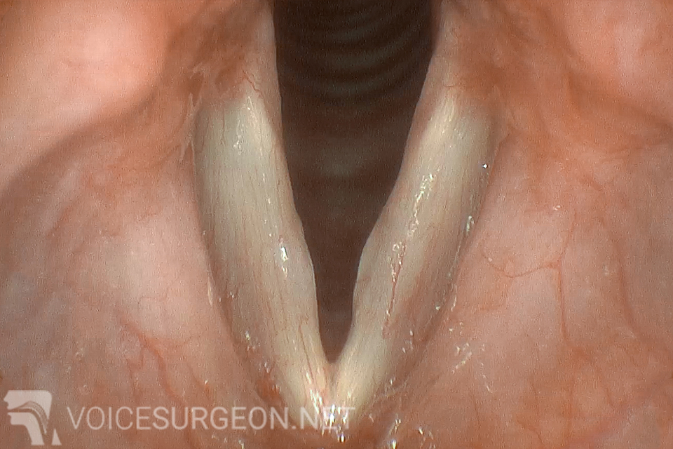 Before Vocal Cord Nodules Cancer Surgery