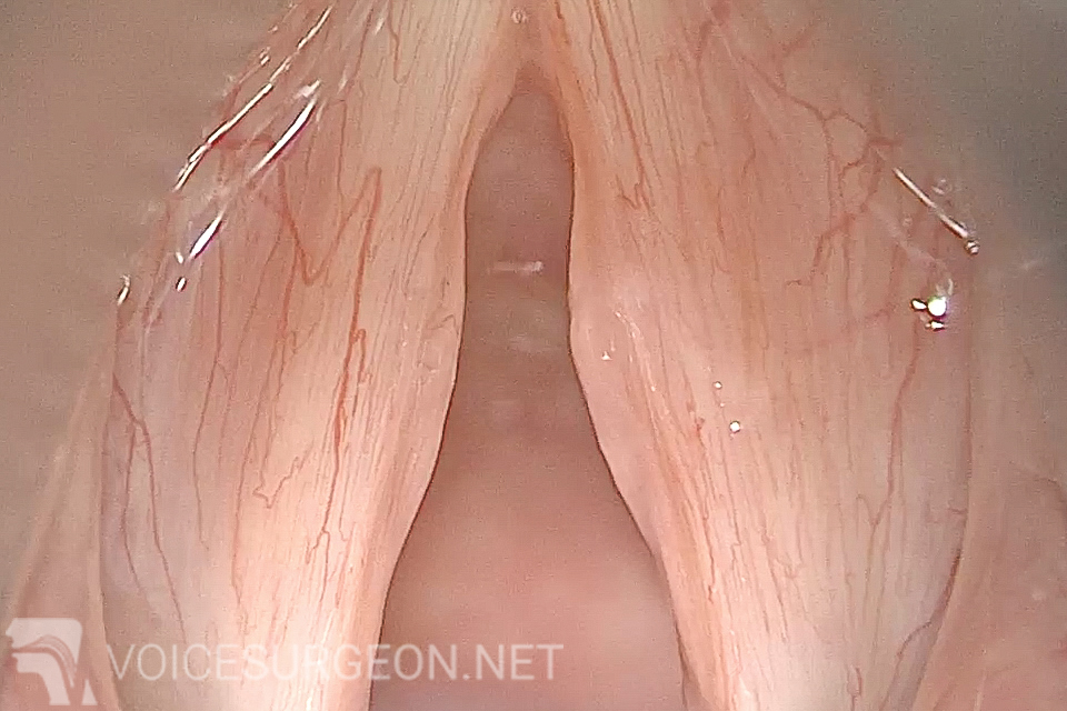 Vocal Cord Nodules Surgery