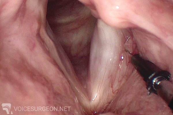 Laryngeal Surgery - Office-Based Vocal Cord Injections
