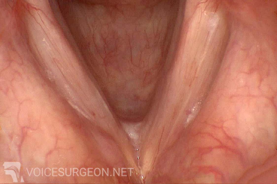 Vocal cord polyp surgery