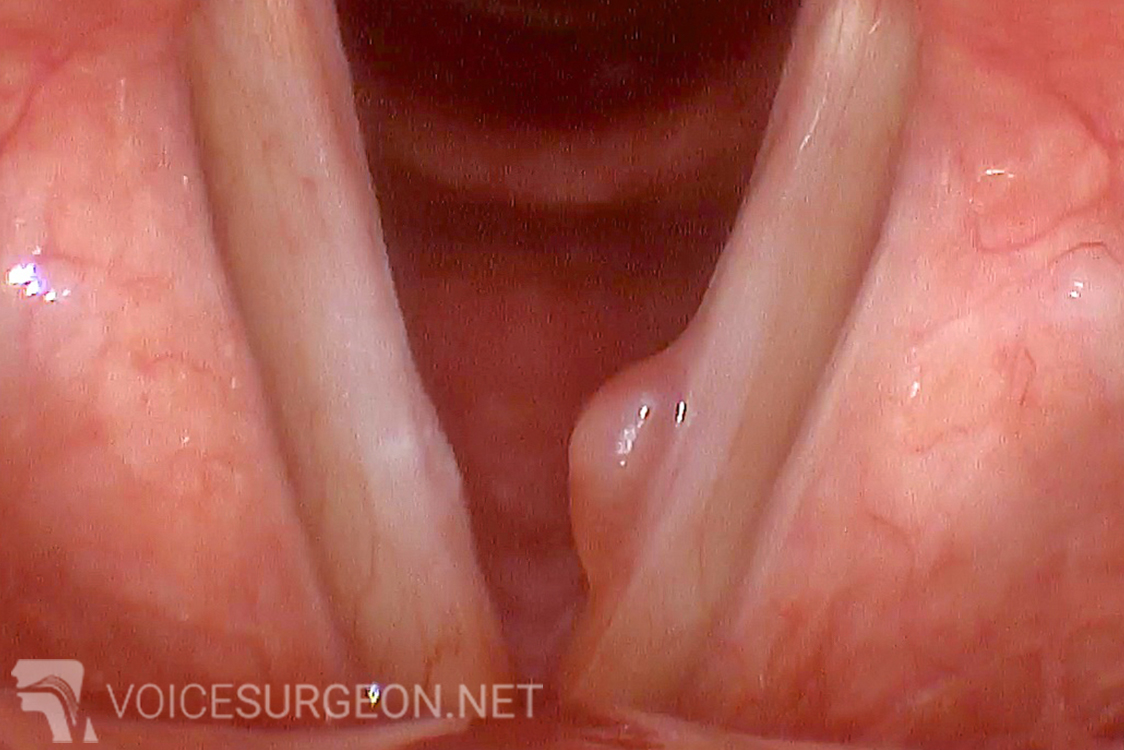 Non-Hemorrhagic Fibrotic Vocal Cord Polyp