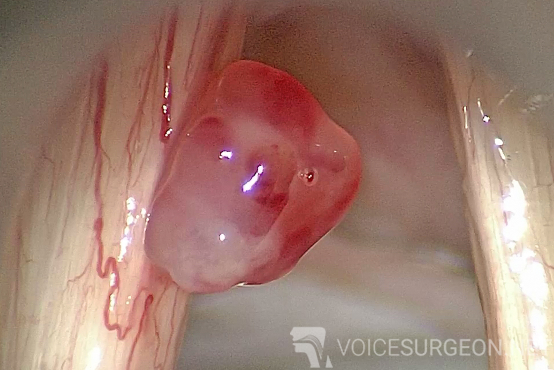 Hemorrhagic Vocal Cord Polyp 