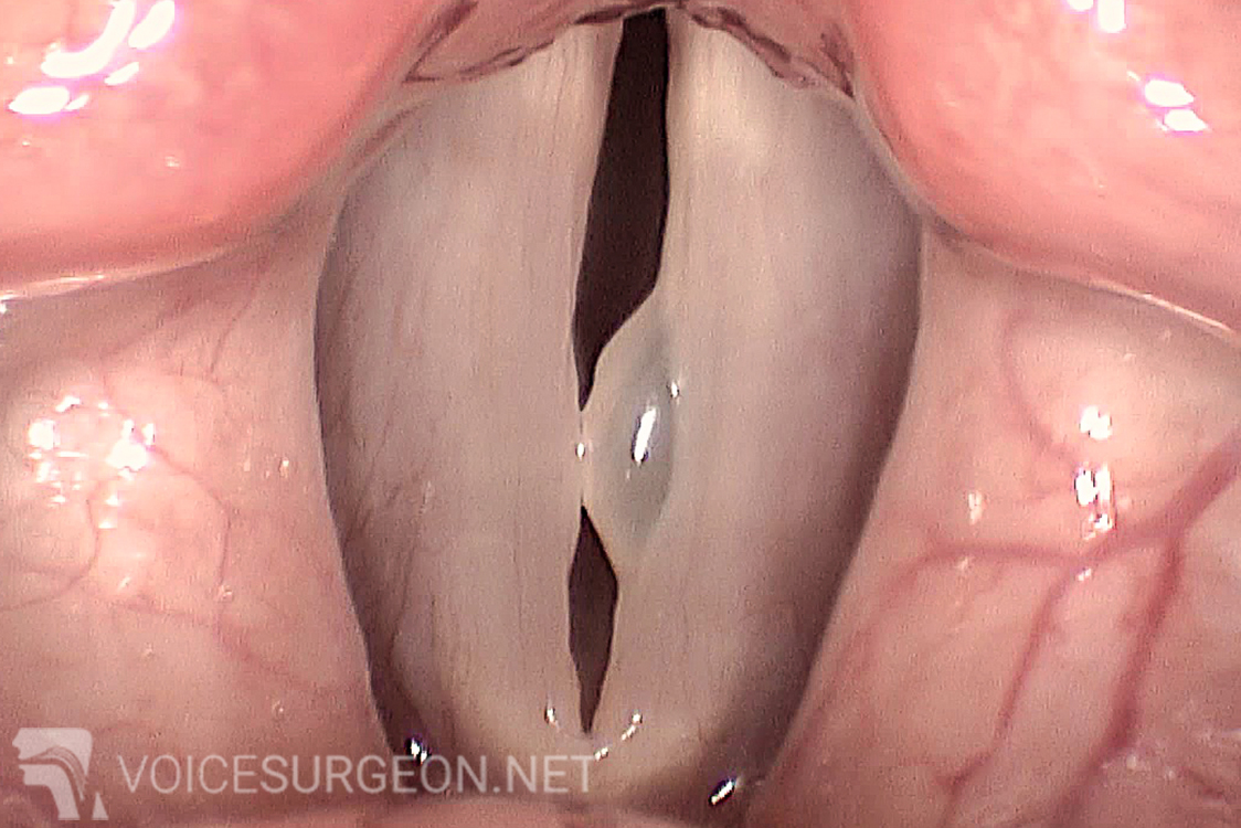 Non-Hemorrhagic Translucent Vocal Cord Polyp 