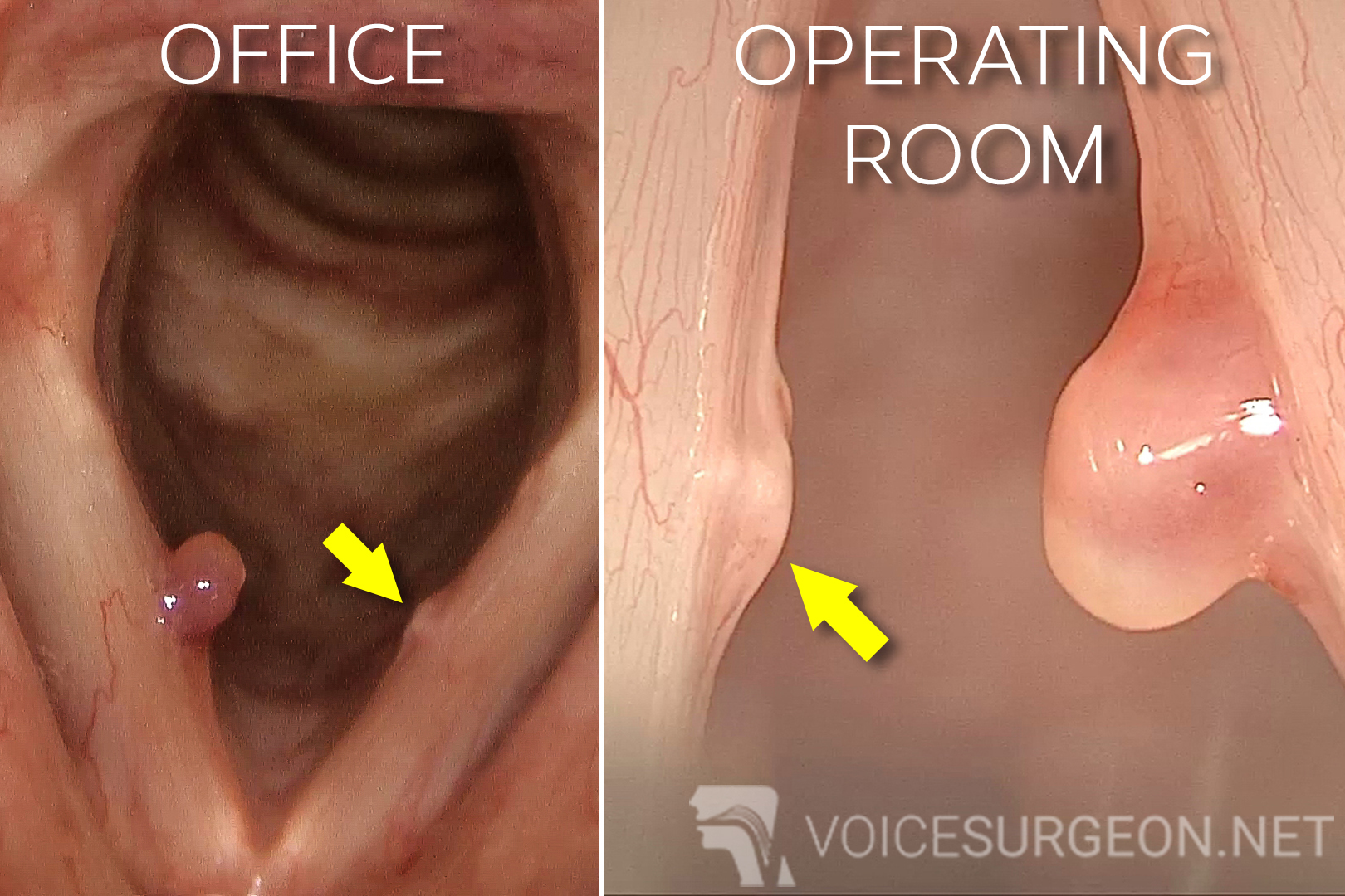 Example of vocal cord polyps 