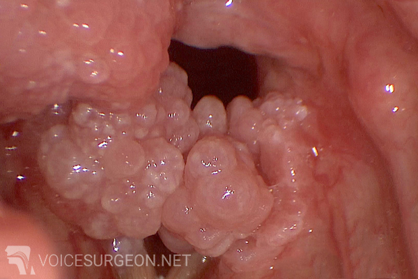 papillomatosis throat