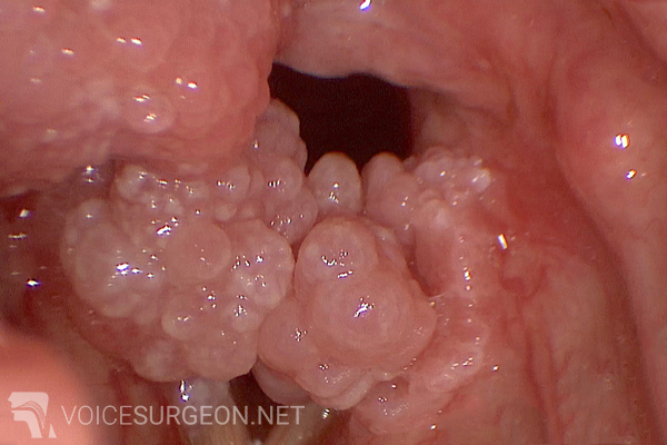 Avastin laryngeal papillomatosis