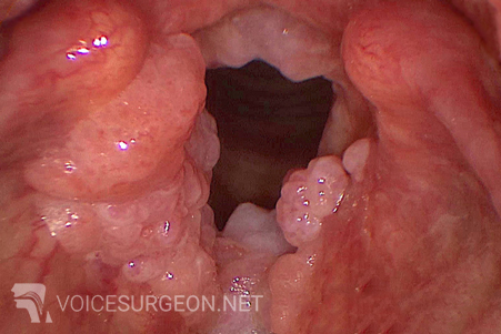 laryngeal papilloma polyp)