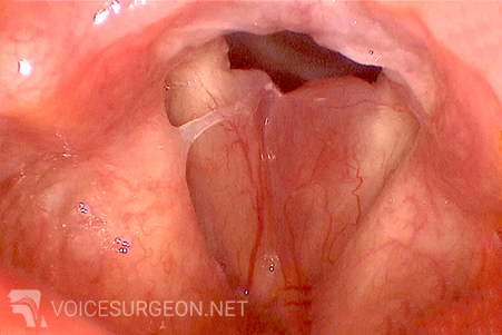 Reinke's Edema - Smokers Polyp of the Vocal Cord - Before Vocal Cord Surgery