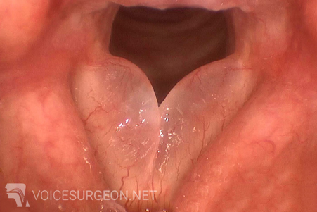 Reinke's Edema - Smokers Polyp of the Vocal Cord
