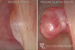 vocal cord polyp surgery